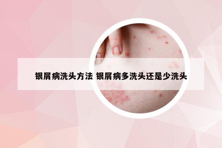 银屑病洗头方法 银屑病多洗头还是少洗头