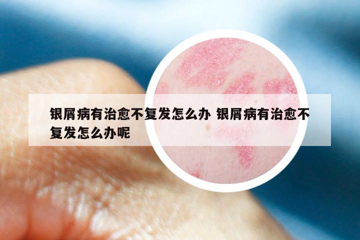 银屑病有治愈不复发怎么办 银屑病有治愈不复发怎么办呢