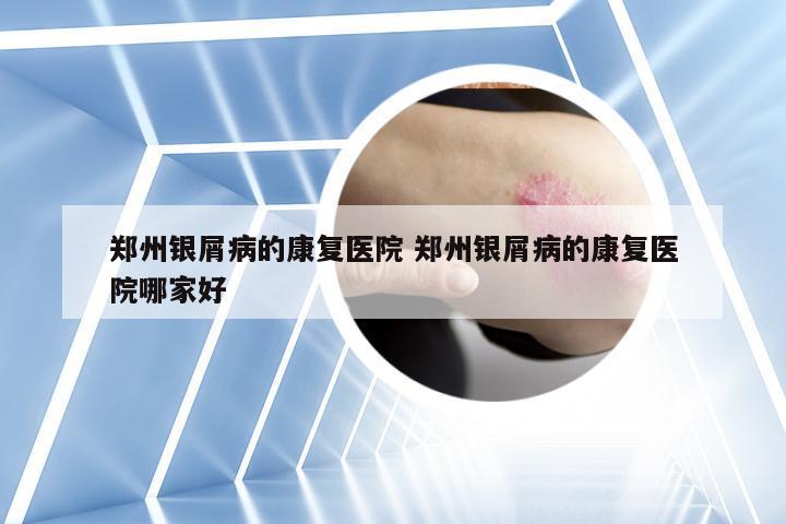 郑州银屑病的康复医院 郑州银屑病的康复医院哪家好