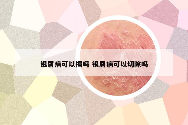 银屑病可以揭吗 银屑病可以切除吗