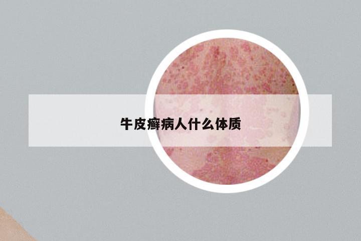 牛皮癣病人什么体质