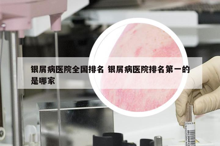 银屑病医院全国排名 银屑病医院排名第一的是哪家