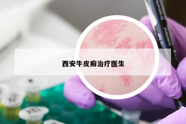 西安牛皮癣治疗医生