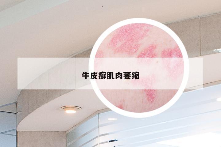 牛皮癣肌肉萎缩