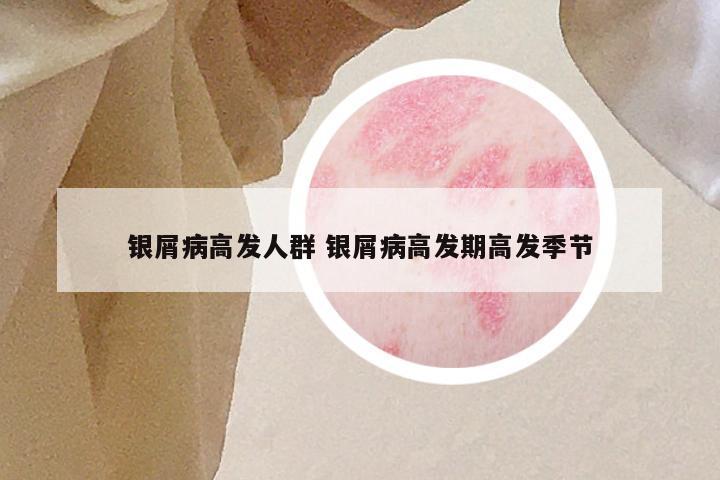 银屑病高发人群 银屑病高发期高发季节