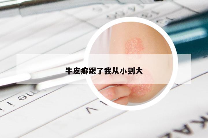 牛皮癣跟了我从小到大
