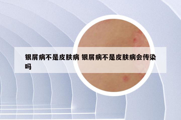 银屑病不是皮肤病 银屑病不是皮肤病会传染吗