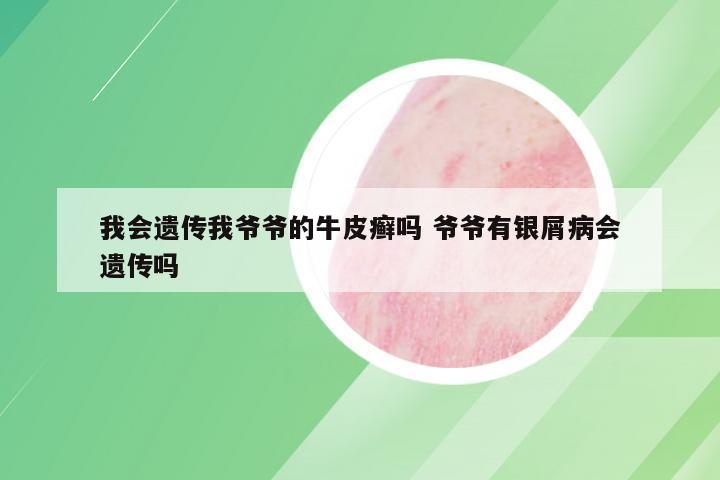 我会遗传我爷爷的牛皮癣吗 爷爷有银屑病会遗传吗