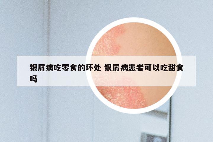 银屑病吃零食的坏处 银屑病患者可以吃甜食吗