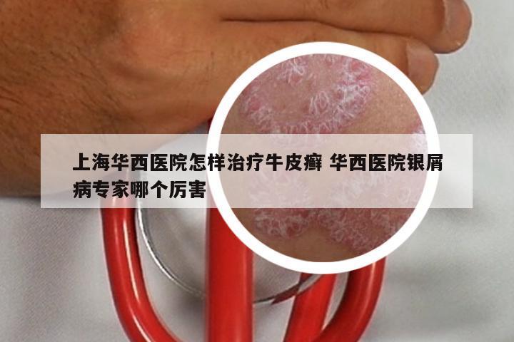 上海华西医院怎样治疗牛皮癣 华西医院银屑病专家哪个厉害