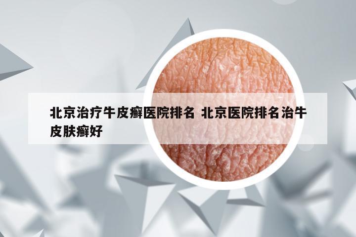 北京治疗牛皮癣医院排名 北京医院排名治牛皮肤癣好
