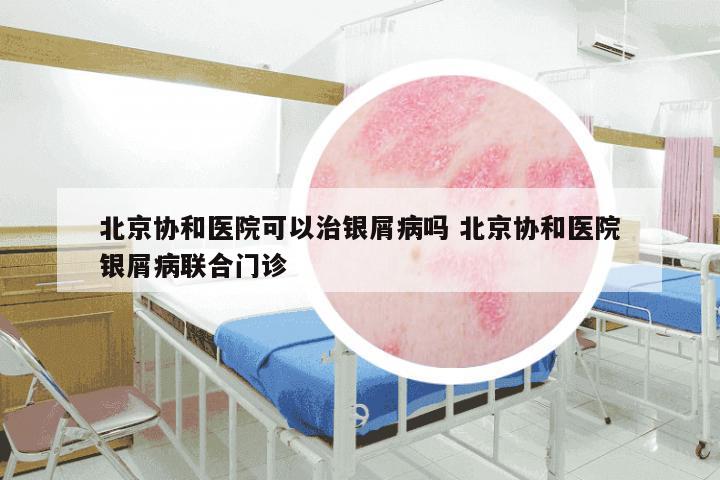 北京协和医院可以治银屑病吗 北京协和医院银屑病联合门诊