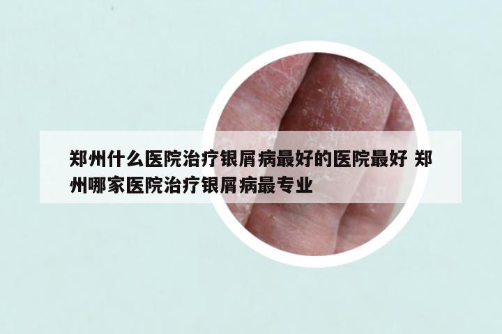 郑州什么医院治疗银屑病最好的医院最好 郑州哪家医院治疗银屑病最专业