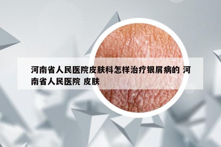 河南省人民医院皮肤科怎样治疗银屑病的 河南省人民医院 皮肤
