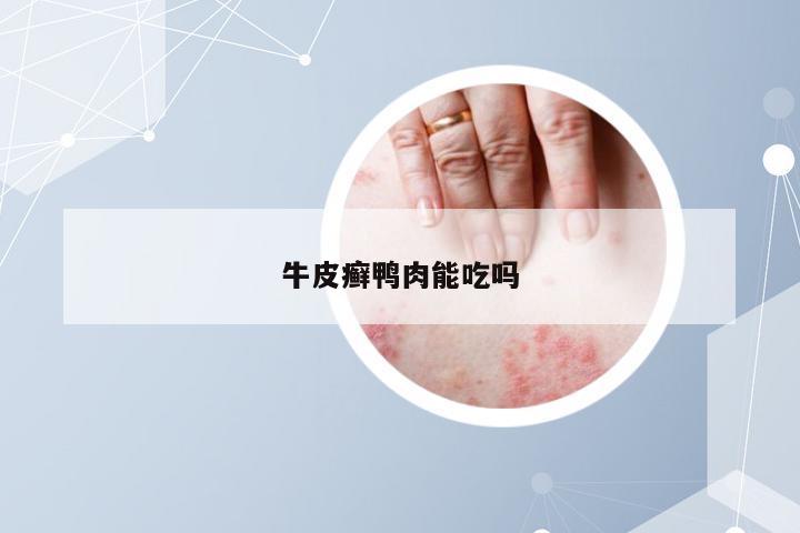 牛皮癣鸭肉能吃吗
