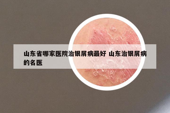 山东省哪家医院治银屑病最好 山东治银屑病的名医