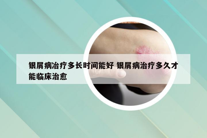 银屑病冶疗多长时间能好 银屑病治疗多久才能临床治愈