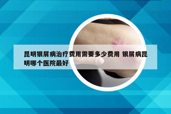 昆明银屑病治疗费用需要多少费用 银屑病昆明哪个医院最好