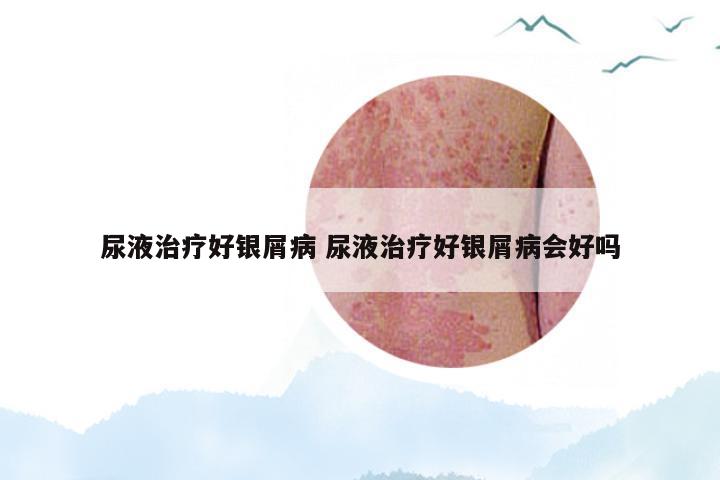 尿液治疗好银屑病 尿液治疗好银屑病会好吗