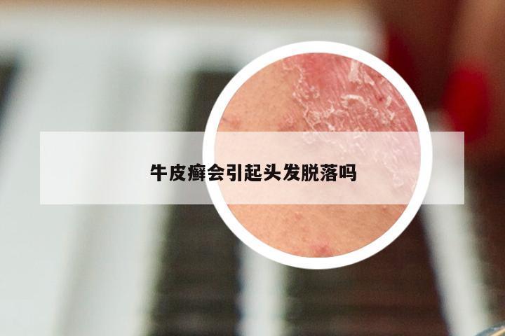 牛皮癣会引起头发脱落吗