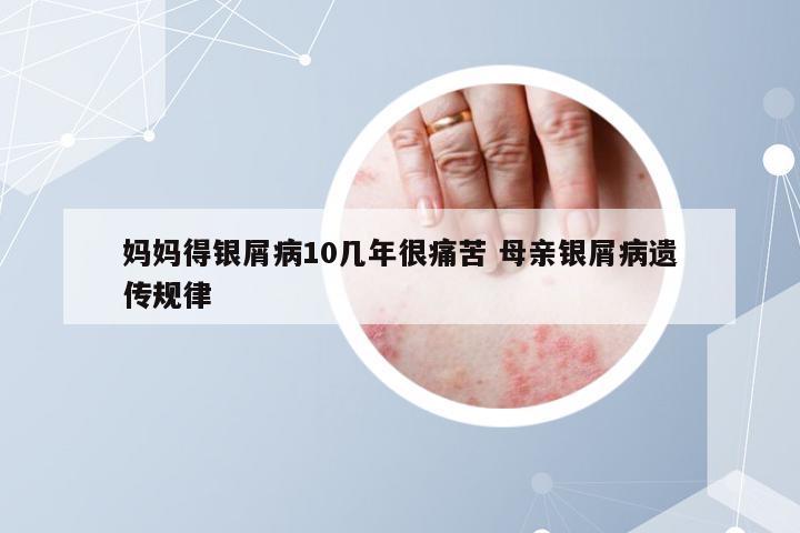 妈妈得银屑病10几年很痛苦 母亲银屑病遗传规律