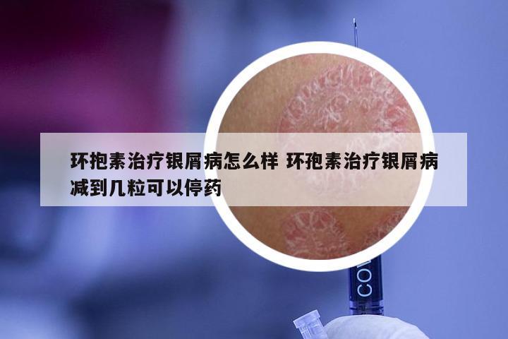 环抱素治疗银屑病怎么样 环孢素治疗银屑病减到几粒可以停药