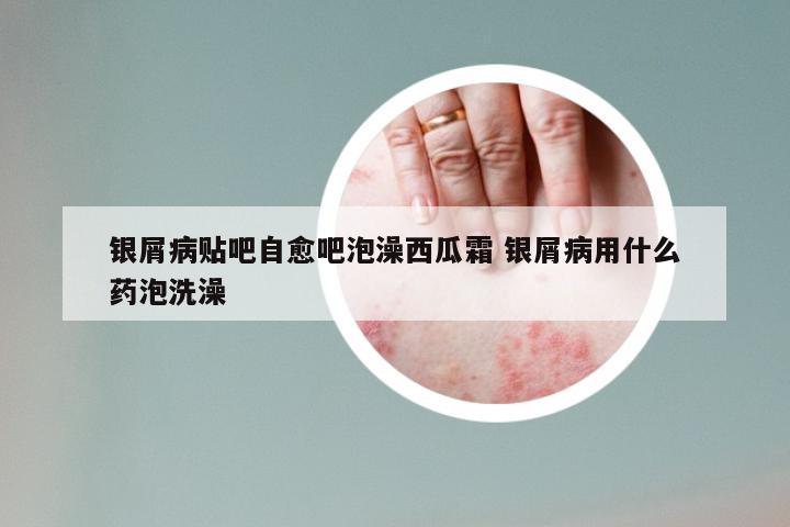 银屑病贴吧自愈吧泡澡西瓜霜 银屑病用什么药泡洗澡