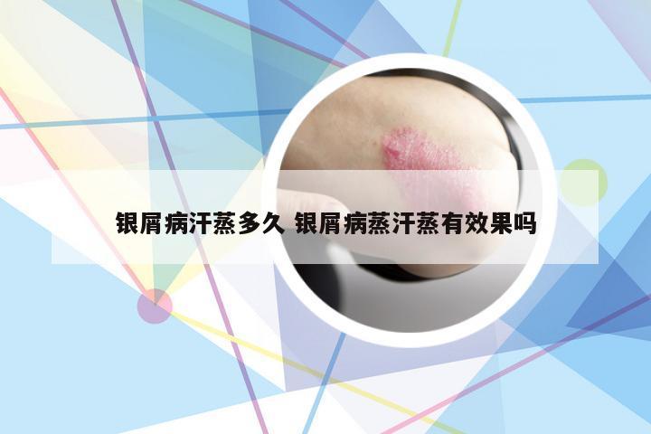 银屑病汗蒸多久 银屑病蒸汗蒸有效果吗