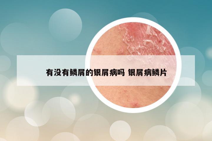 有没有鳞屑的银屑病吗 银屑病鳞片