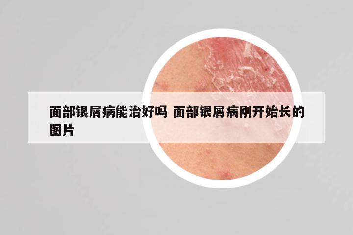 面部银屑病能治好吗 面部银屑病刚开始长的图片