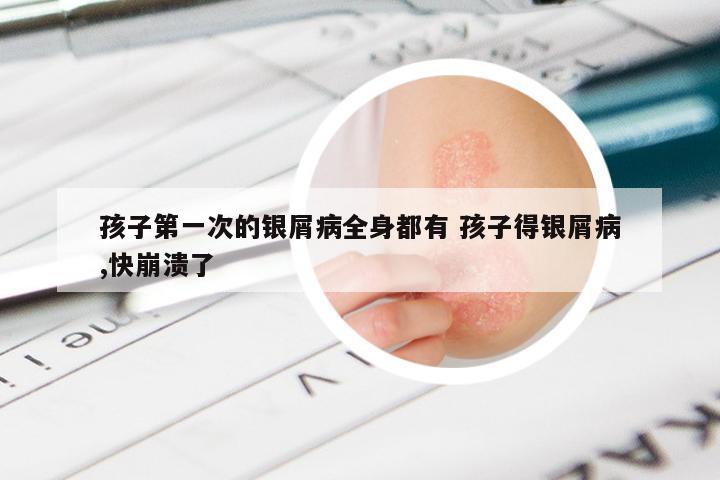 孩子第一次的银屑病全身都有 孩子得银屑病,快崩溃了