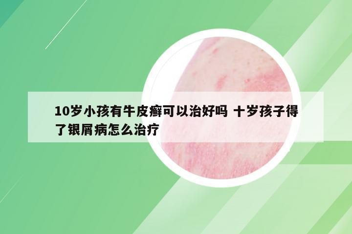 10岁小孩有牛皮癣可以治好吗 十岁孩子得了银屑病怎么治疗