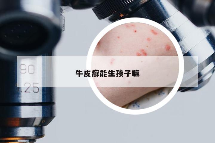 牛皮癣能生孩子嘛