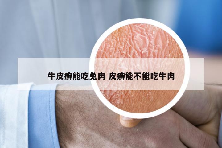 牛皮癣能吃兔肉 皮癣能不能吃牛肉