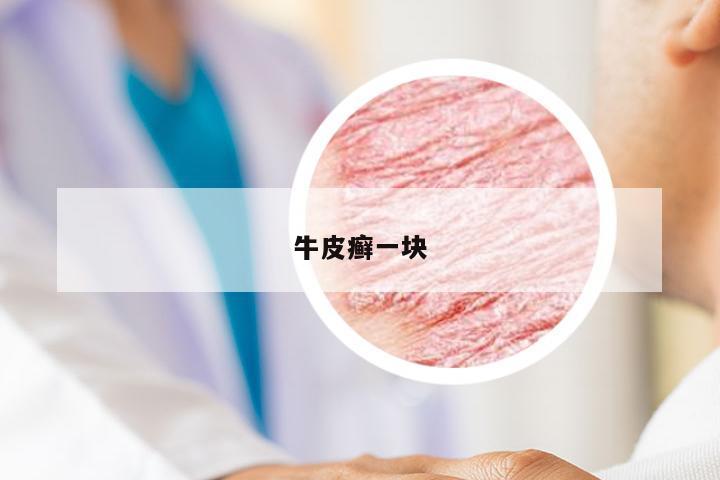牛皮癣一块