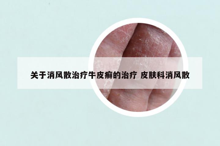 关于消风散治疗牛皮癣的治疗 皮肤科消风散