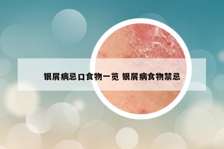 银屑病忌口食物一览 银屑病食物禁忌