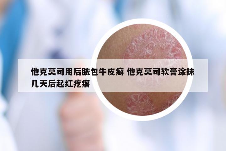 他克莫司用后脓包牛皮癣 他克莫司软膏涂抹几天后起红疙瘩