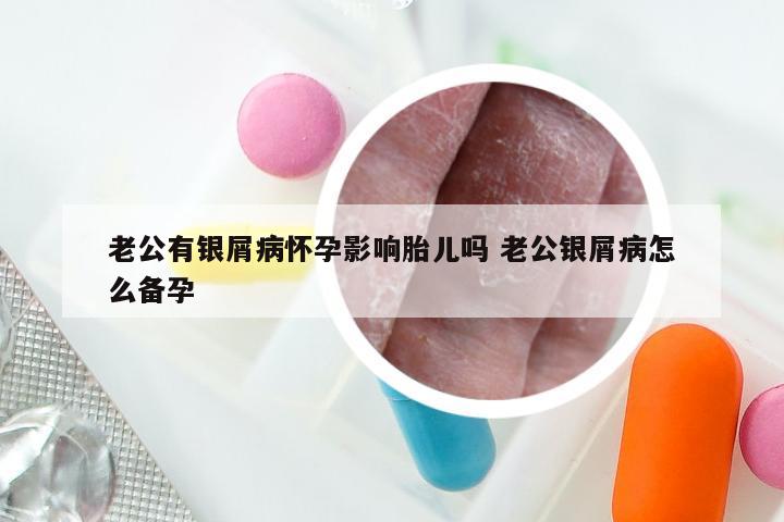 老公有银屑病怀孕影响胎儿吗 老公银屑病怎么备孕