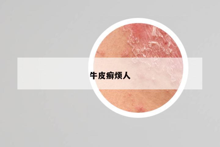 牛皮癣烦人