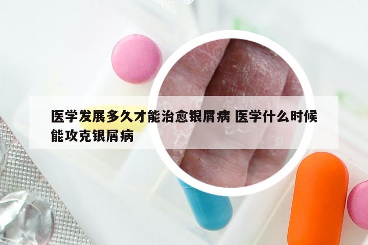 医学发展多久才能治愈银屑病 医学什么时候能攻克银屑病