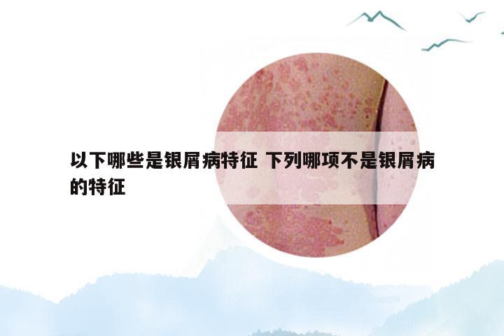 以下哪些是银屑病特征 下列哪项不是银屑病的特征
