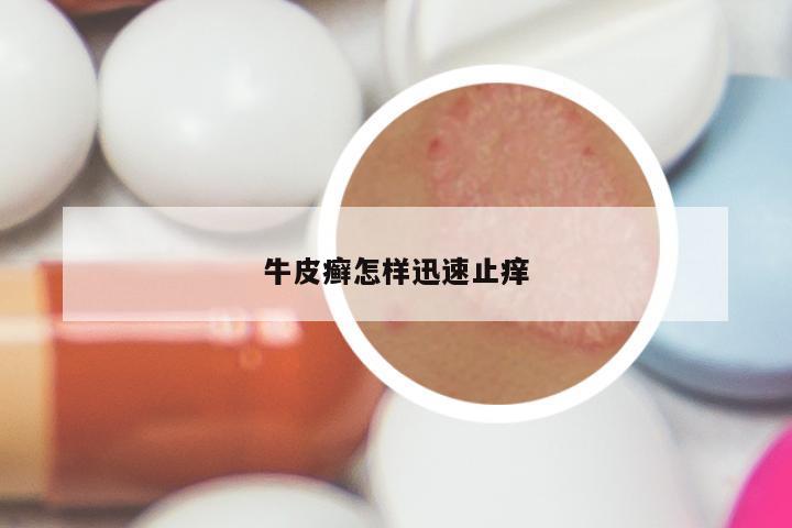 牛皮癣怎样迅速止痒