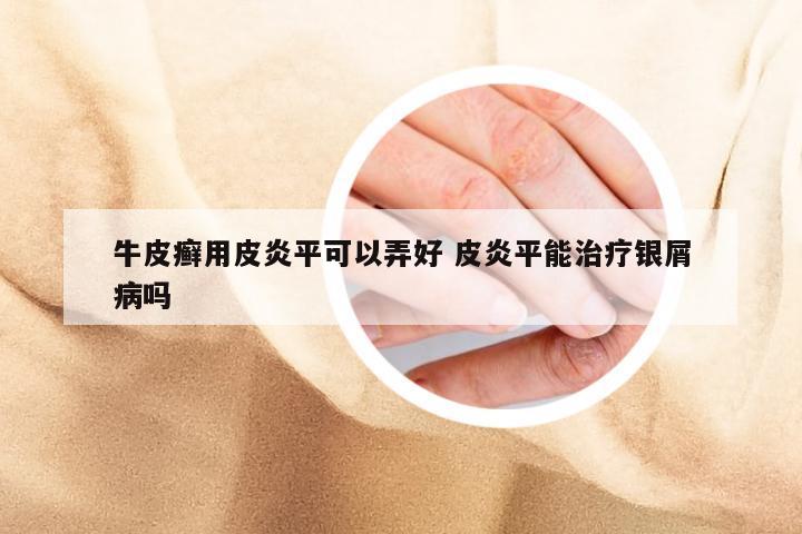 牛皮癣用皮炎平可以弄好 皮炎平能治疗银屑病吗