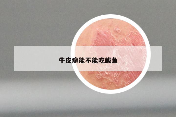 牛皮癣能不能吃鲅鱼