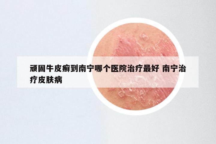 顽固牛皮癣到南宁哪个医院治疗最好 南宁治疗皮肤病