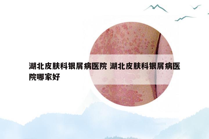 湖北皮肤科银屑病医院 湖北皮肤科银屑病医院哪家好