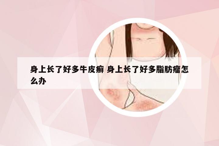 身上长了好多牛皮癣 身上长了好多脂肪瘤怎么办