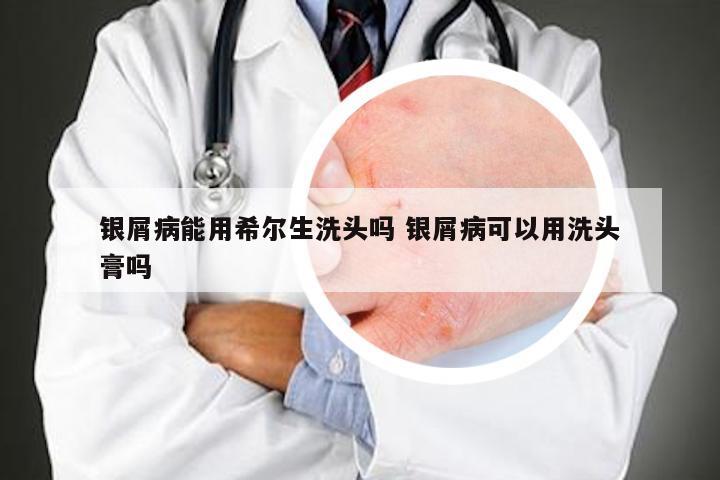 银屑病能用希尔生洗头吗 银屑病可以用洗头膏吗