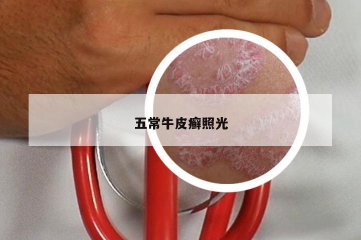 五常牛皮癣照光